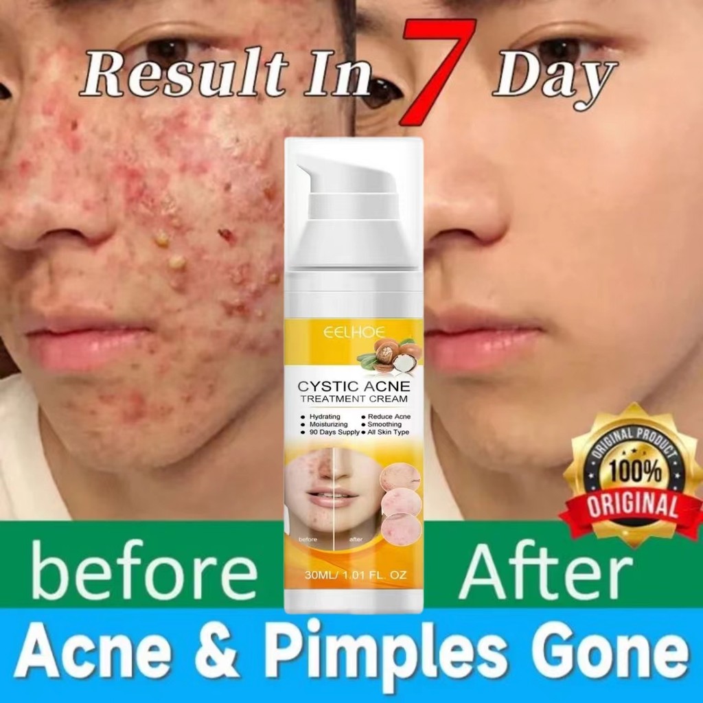 EELHOE obat cina jerawat ampuh /obat jerawat cina paling ampuh /ANTI-ACNE Skin CREAM / Salep Krim Me