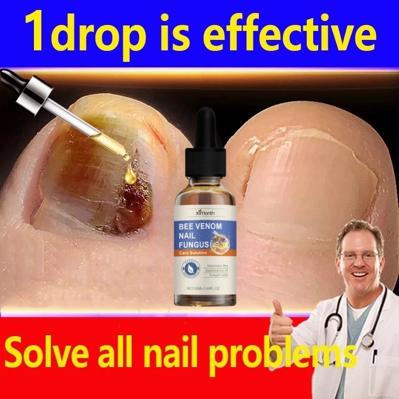 Nail Repair Essence Serum Memperbaiki Kuku Rusak Penghilang Jamur Kuku Gel Gel Anti Infeksi Obat Kuk