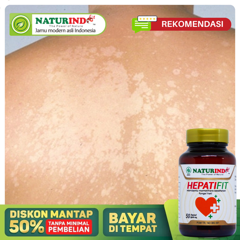 Obat Panu Paling Ampuh Balas Bogo Hapuran Kulit Gatal Jamur Panuan Di Wajah Muka Leher Badan Hapur P
