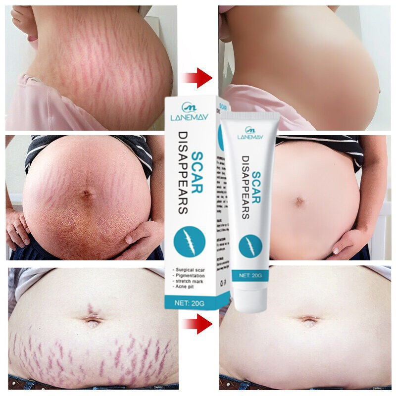 Penghilang Bekas Luka Hitam 20g Penghilang Bekas Luka Hitam & Stretch Mark Penghilang Bekas Luka Kak