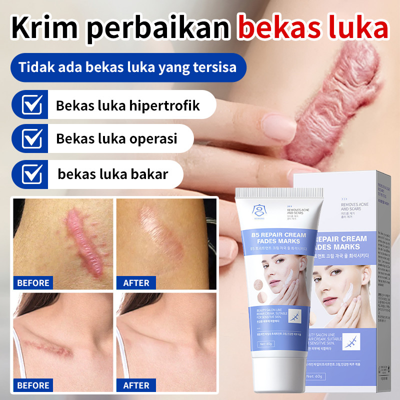✨3 Minggu[Pengiriman 24 jam]✨scar cream/Krim Perbaikan Bekas Jerawat & Luka/ salep bekas luka operas