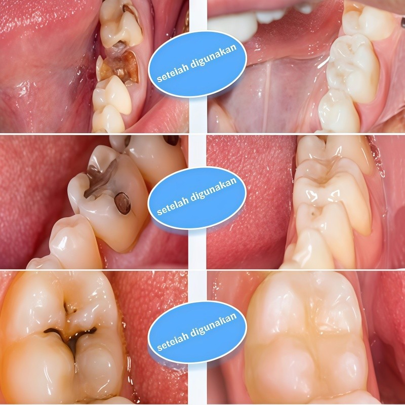 JHN01 Obat Tetes Abses Gusi - Obat Gusi Bernanah Radang Dan Nyeri Gusi - Obat Gusi Bengkak - Obat