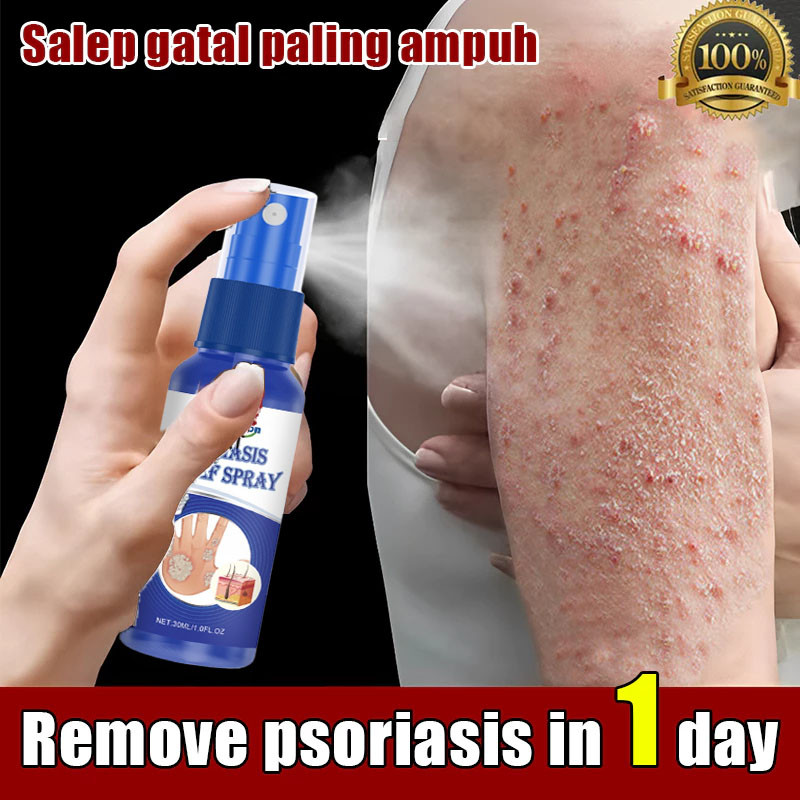 Salep gatal paling ampuh spray gatal selangkangan salep gatal kulit yang ampuh Salep gatal selangkan