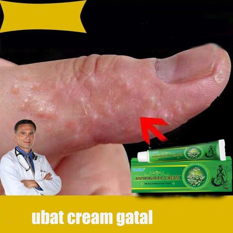 100% original Eczema Treatment Cream, Antipruritic Cream, Chinese Herbal Crem, Eczema Psoriasis Anti
