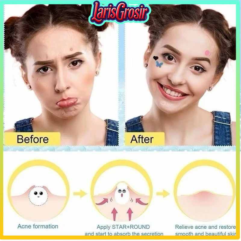 COD makassar Acne Pimple Patch 1 Lembar Isi 36 Patch / Stiker Jerawat Hydrocolloid / Sticker Perawat