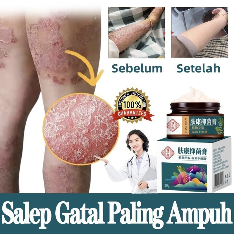 salep gatal paling ampuh salep eksim Obat psoriasis Anti jamur Salep salep gatal selangkangan selang