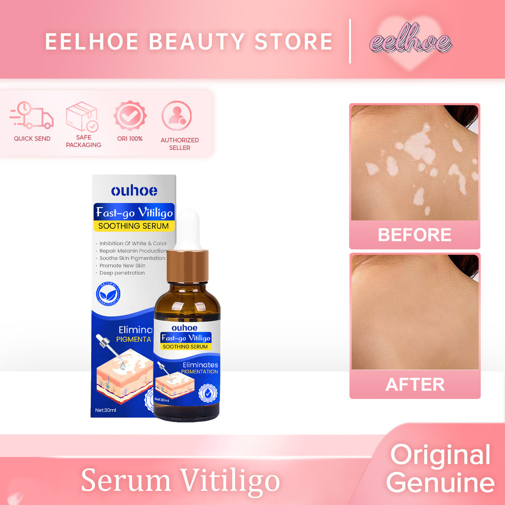 Pengobatan Vitiligo Obat Vitiligo Ampuh /Protopic Vitiligo Alep Vitiligo, Panu, Biang Keringat, Sale