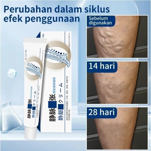 Obat Varises / Cream Varises / Salep Penghilang Varises Vaskulitis Ampuh / Basmi Varises Ampuh Tanpa