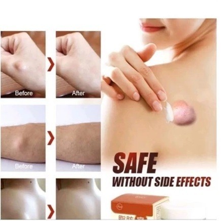 Obat Benjolan Paling Ampuh / Bao Jian Gao Salep Obat Benjolan Lipoma Pada Tubuh / Obat Lipoma