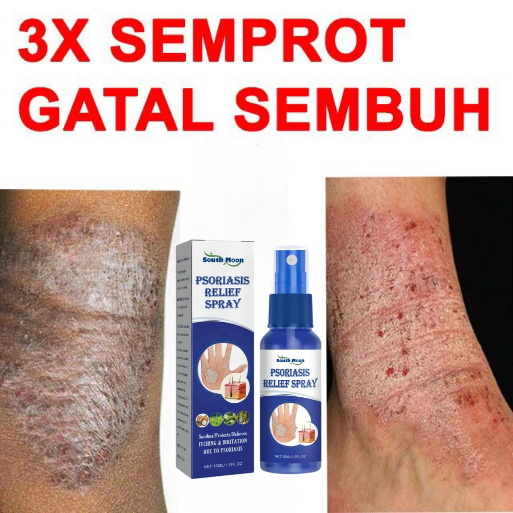 spray gatal Salep khusus psoriasis spray jamur kulit kurap pada kulit kepala kutu air kurap pada