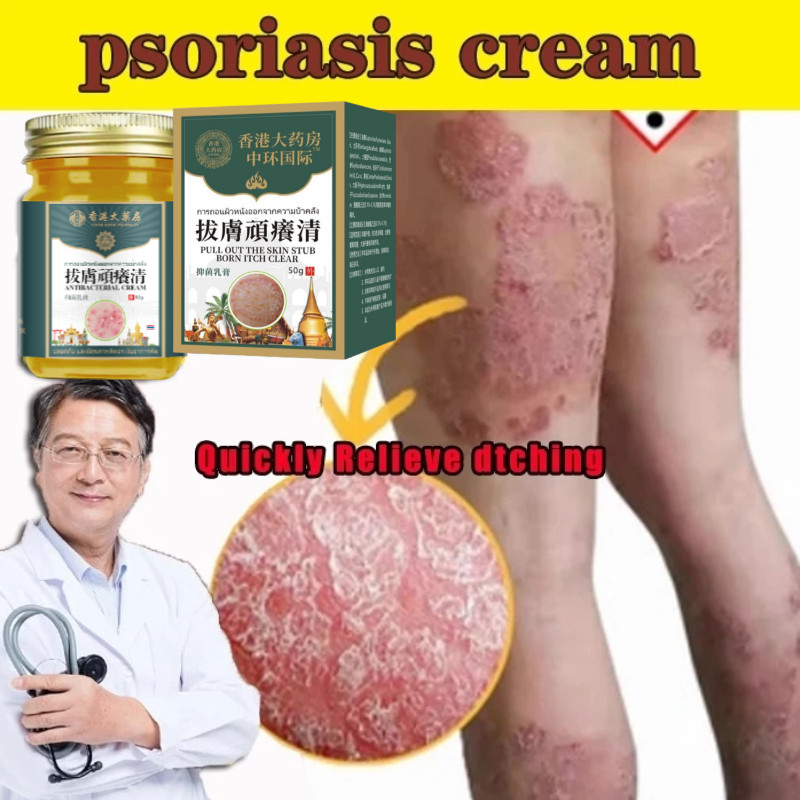 Krim Psoriasis Krim Antijamur Krim Eksim Salep Kulit Serbaguna – Gatal, Jamur & Psoriasis Hilang 3 H
