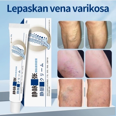 Obat Varises / Cream Varises / Salep Penghilang Varises Vaskulitis Ampuh / Basmi Varises Ampuh Tanpa