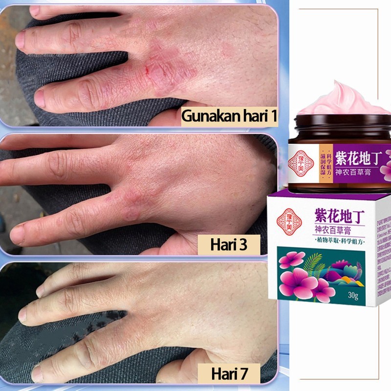 Salep gatal paling ampuh Obat gatal selangkangan salep gatal kulit yang ampuh 30g Salep gatal selang