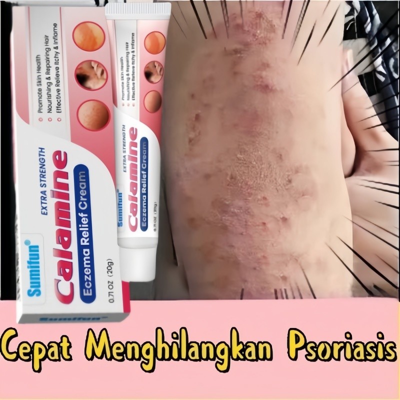 Salep Gatal Paling Ampuh Obat Gatal Kulit Eczema Cream Untuk Orang Yang Tua Dan Anak Untuk Seluruh T
