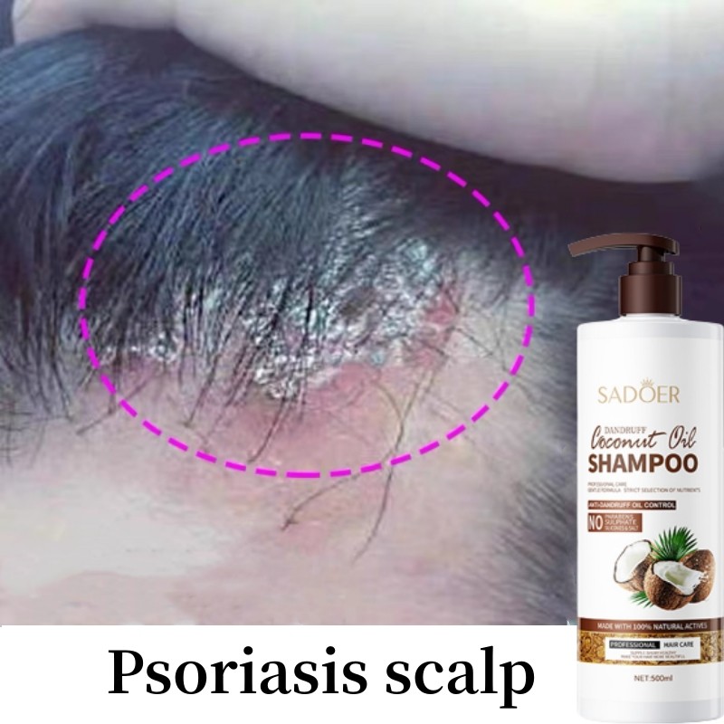 50% Discounted Shampoo anti ketombe Penghilang ketombe berkerak Penghilang psoriasis Kulit Kepala da