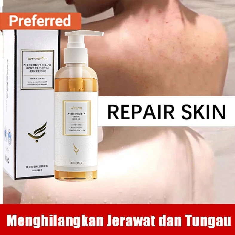 Eczema body wash 260ml Pengobatan Eksim psoriasis eksim kering Kurap gatal kulit jamur kulit eksim l
