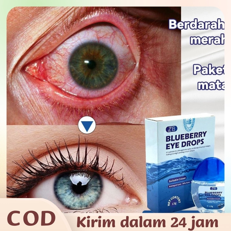 Obat Mata Minus /Tetes Mata Minus/ Katarak/ Silinder/Obat tetes mata obat mata minus obat mata katar