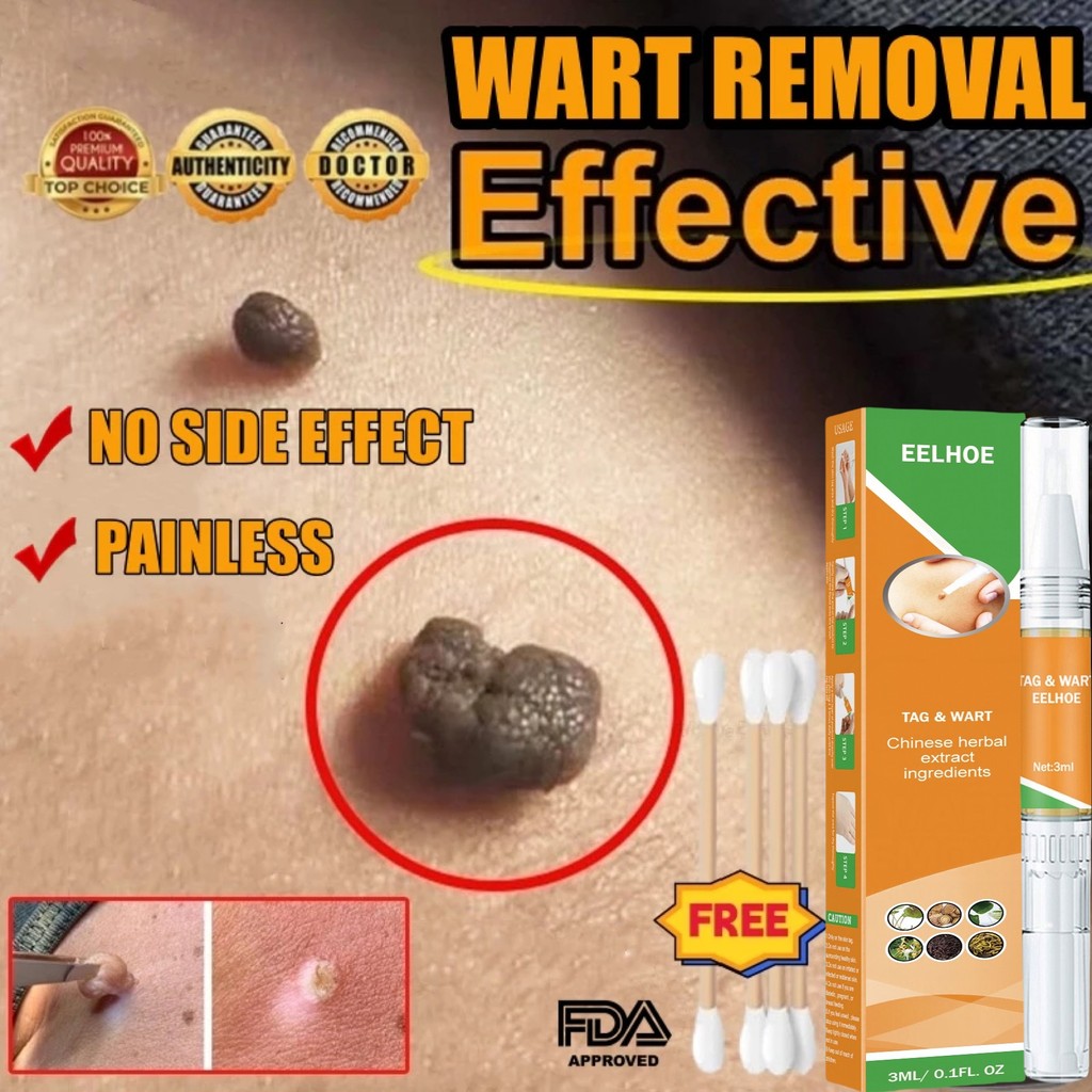 2PCS Obat penghilang tahi lalat obat penghilang kutil obat kutil paling ampuh 100%Original obat kuti