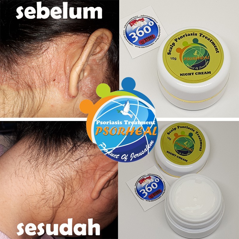 Cream krim Malam salep Psoriasis kulit khusus kepala scalp ketombe parah Psorheal made in Israel