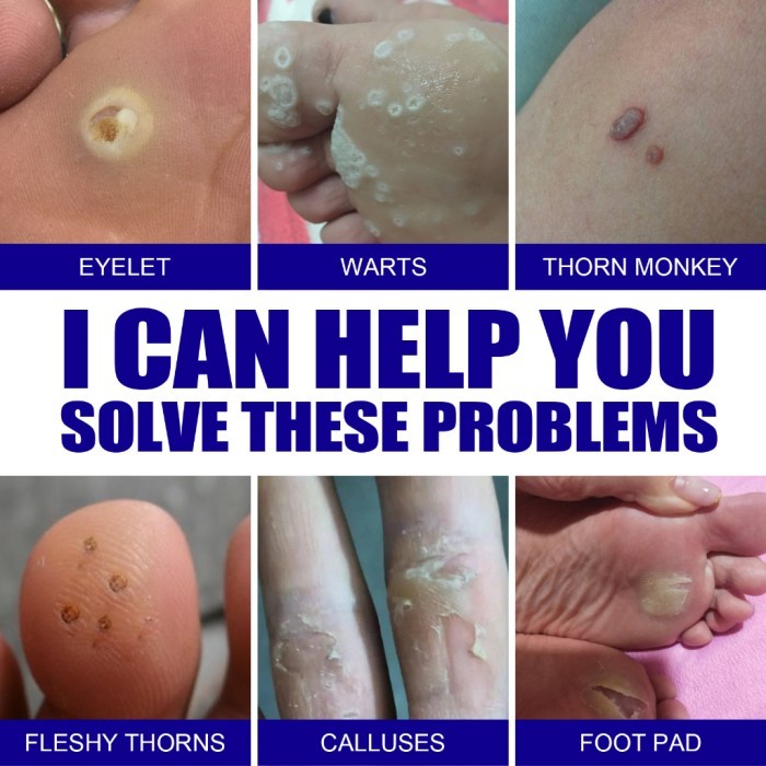 Ouhoe Wart Remover Cream Body Warts Removal Cream Foot Care Cream Antibacterial Skin Tag Warts Remov