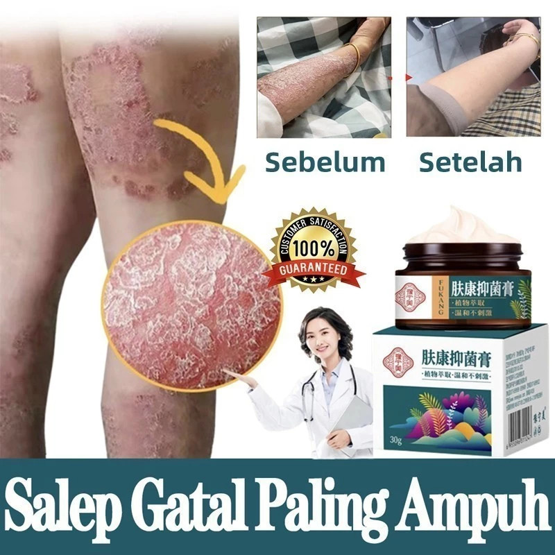 salep gatal paling ampuh salep eksim Obat psoriasis Anti jamur Salep salep gatal selangkangan selang
