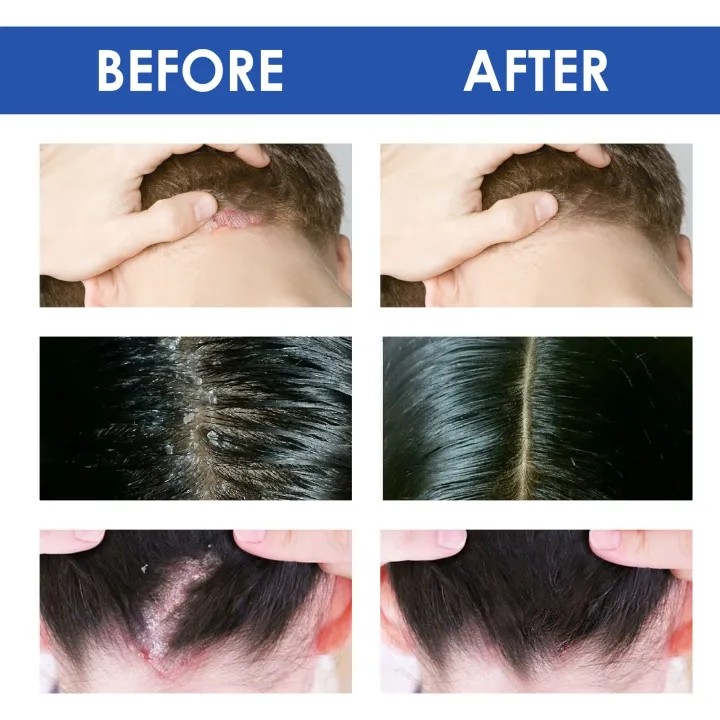 AMND Rambut Psoriasis Perawatan Kulit Seboroik Perawatan Dermatitis Eksim Kepala Jerawat Pruritus