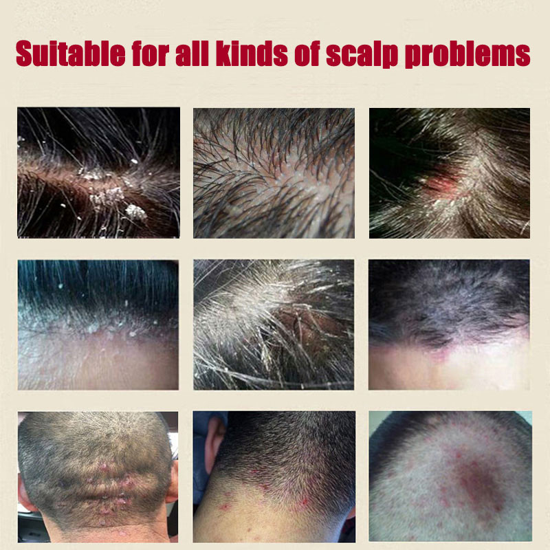 ISA Rambut Psoriasis Perawatan Kulit Seboroik Perawatan Dermatitis Eksim Kepala Jerawat Pruritus