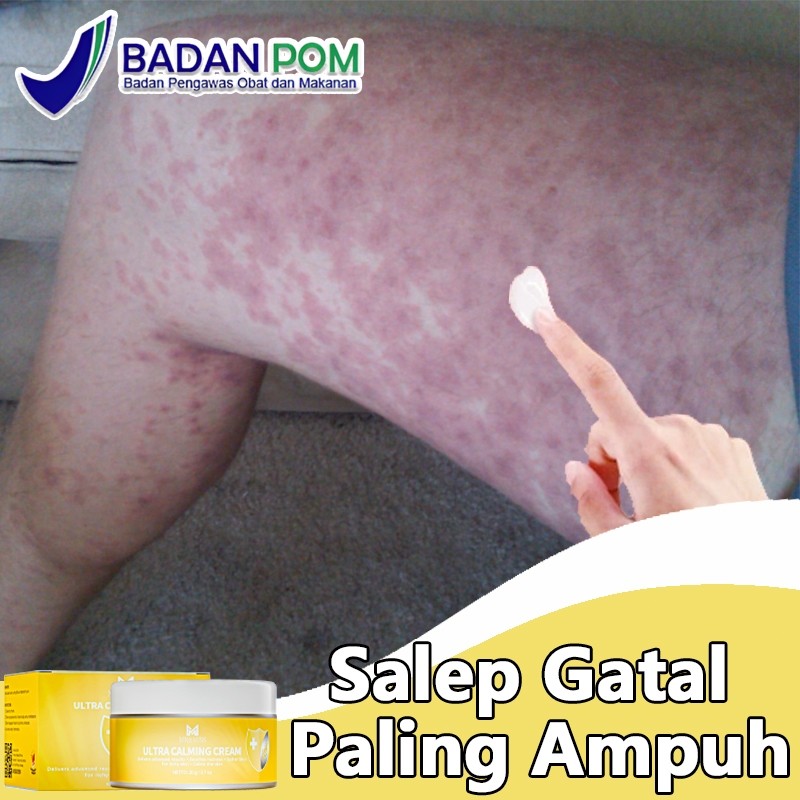 Salep selangkangan gatal dan jamur obat gatal kulit obat gatal selangkangan 20ml Salep selangkangan 