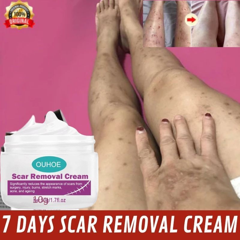 [TOKOMURAH] Scar Remover Cream Penghilang Bekas Luka Koreng
