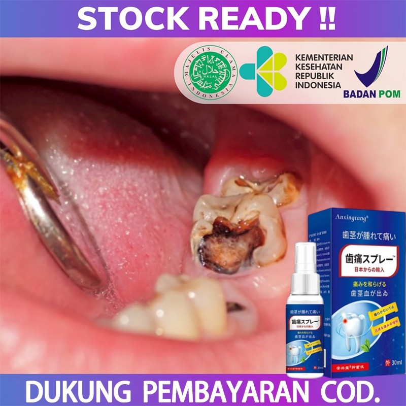 Obat Gigi Berlubang, Penghancur gigi berlubang, gigi sering nyut nyutan, Gusi Bengkak, Gigi Ngilu, R