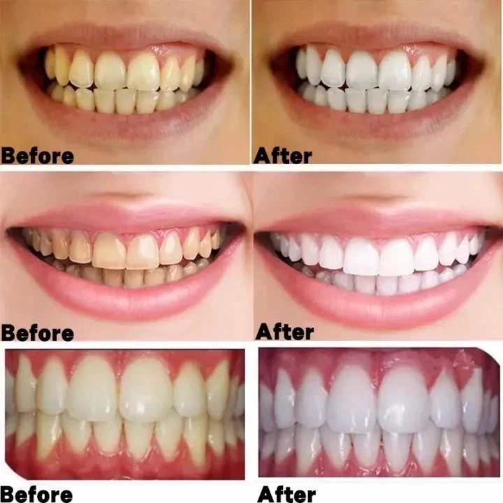 Perontok karang gigi paling ampuh Pembersih karang gigi Penghilang karang gigi 30ml Perontok karang