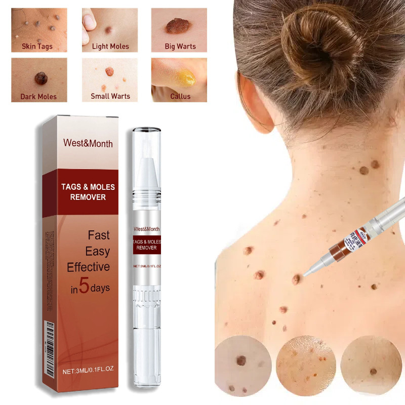 Penghilang Tahi Lalat Penghilang Kutil Skin Tag Remover Penghilang Tahi Lalat Penghilang Kutil Dan T