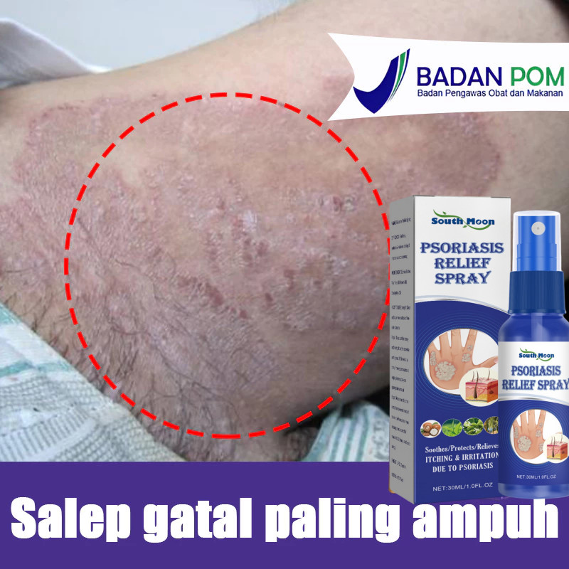 Salep Gatal Paling Ampuh Anti Jamur Salep Salep Gatal Selangkangan Salep Gatal Pada Salep