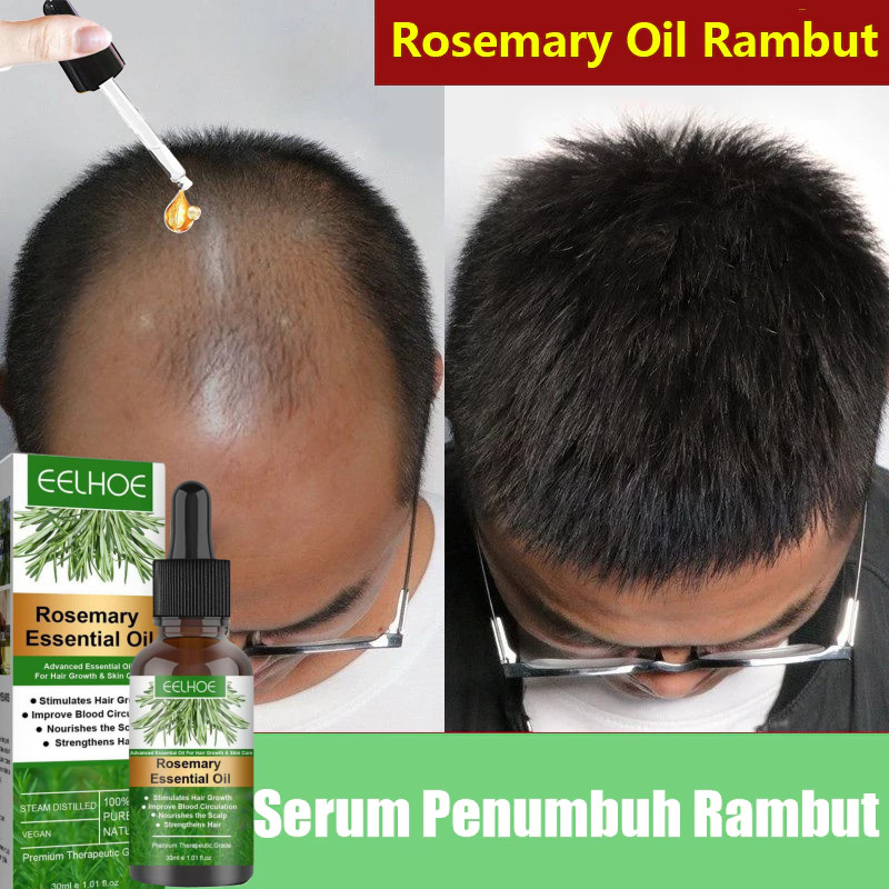 30ml Rosemary Oil Rambut Penumbuh Rambut Botak Perawatan Rambut Rontok Penumbuh Rambut Cepat Hair Gr