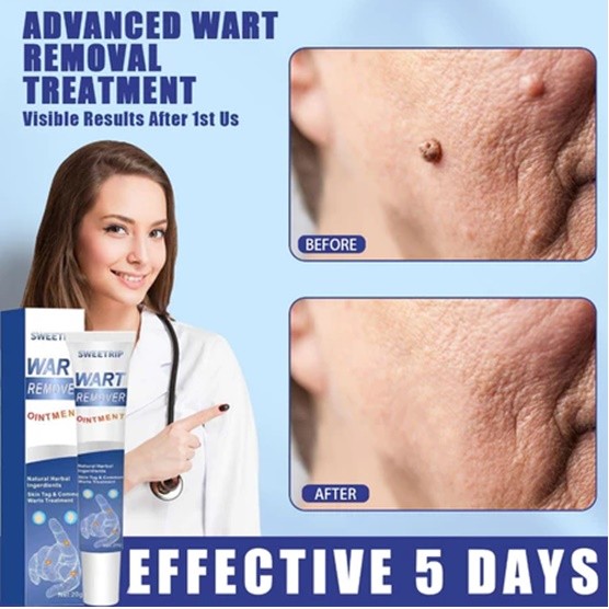 EELHOE Sumifun Wart Removal Skin Tag Eelhoe Wart Remover 100% Original Penghilang Tahi Lalat & Kutil