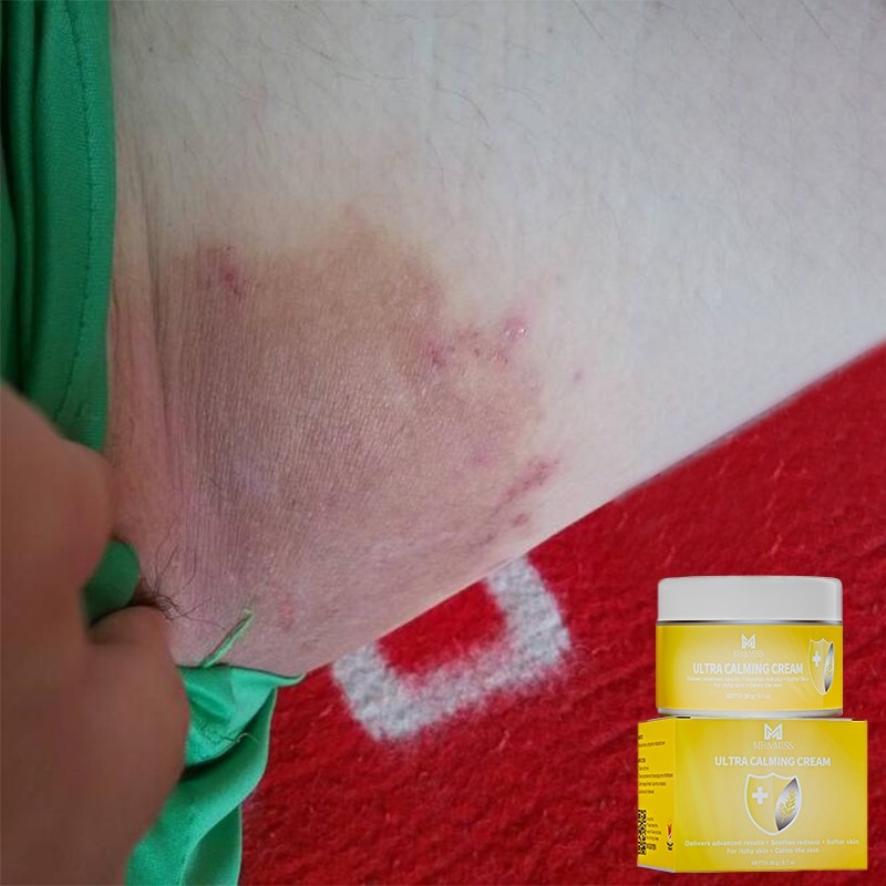 Obat gatal salep gatal selangkangan salep gatal china paling ampuh salep eksim kering paling ampuh 2