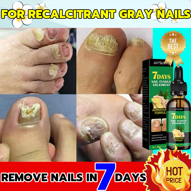 7 daysObat Jamur Kuku Nail repair serum perawatan kuku jamur rusak dan cantengan kaki tangan
