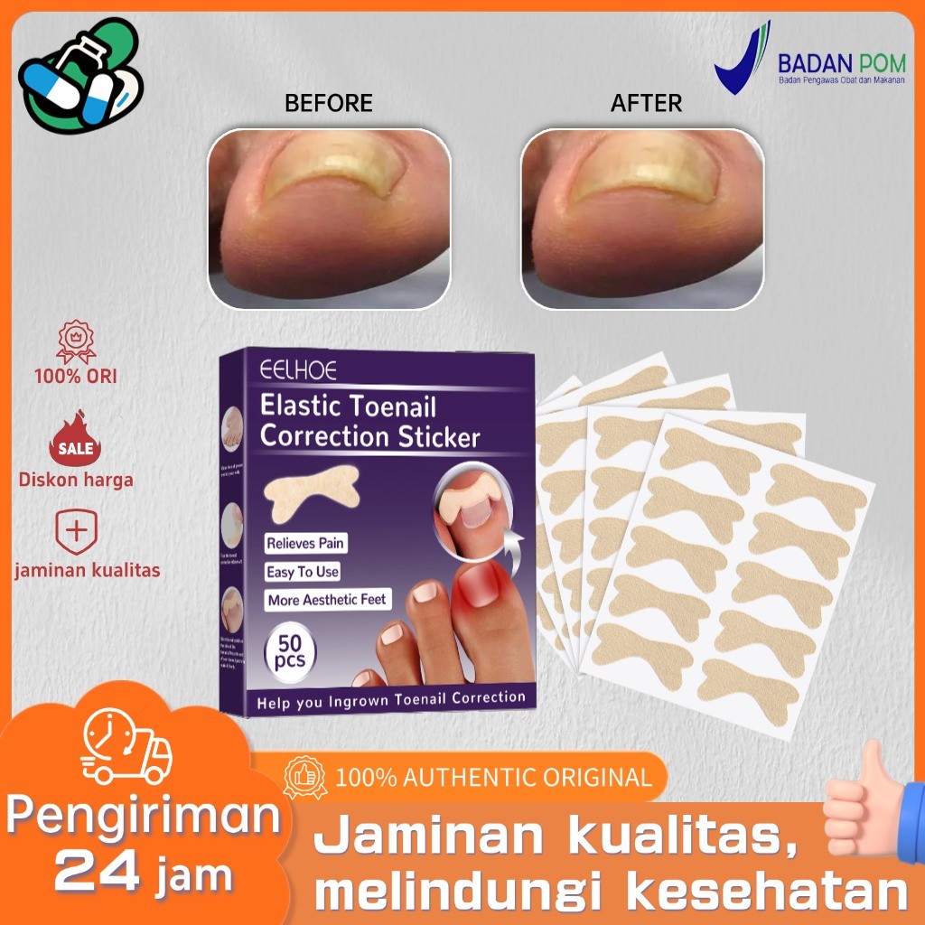 EELHOE elastic toenail sticker 50pcs  Nail Inserts Nail Groove Stiker Kuku Kaki  Nail Repair Ingrown