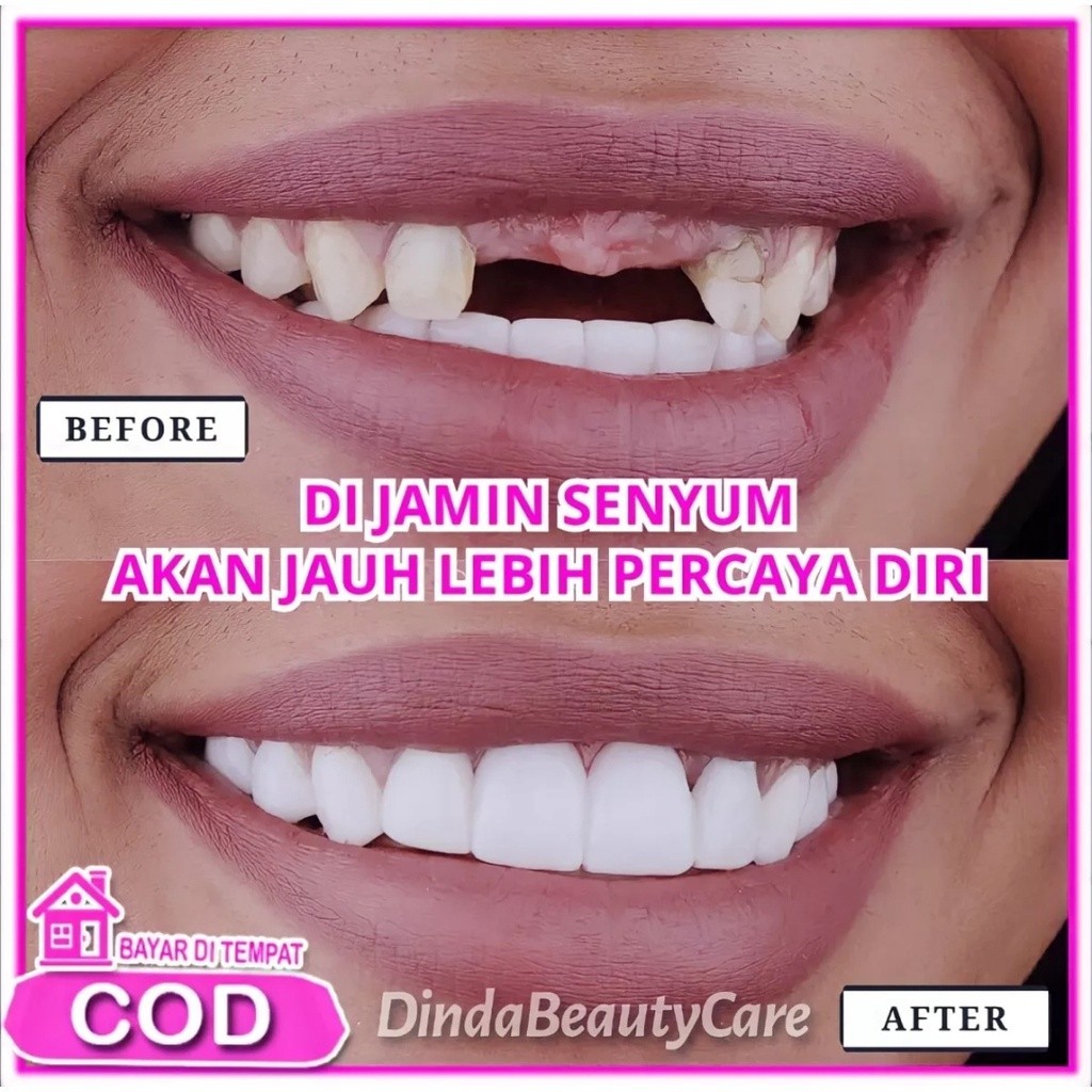 1 Set Gigi Palsu Instan Atas Bawah Penutup Ompong Lepas Pasang Snap on Smile Original Gigi palsu per