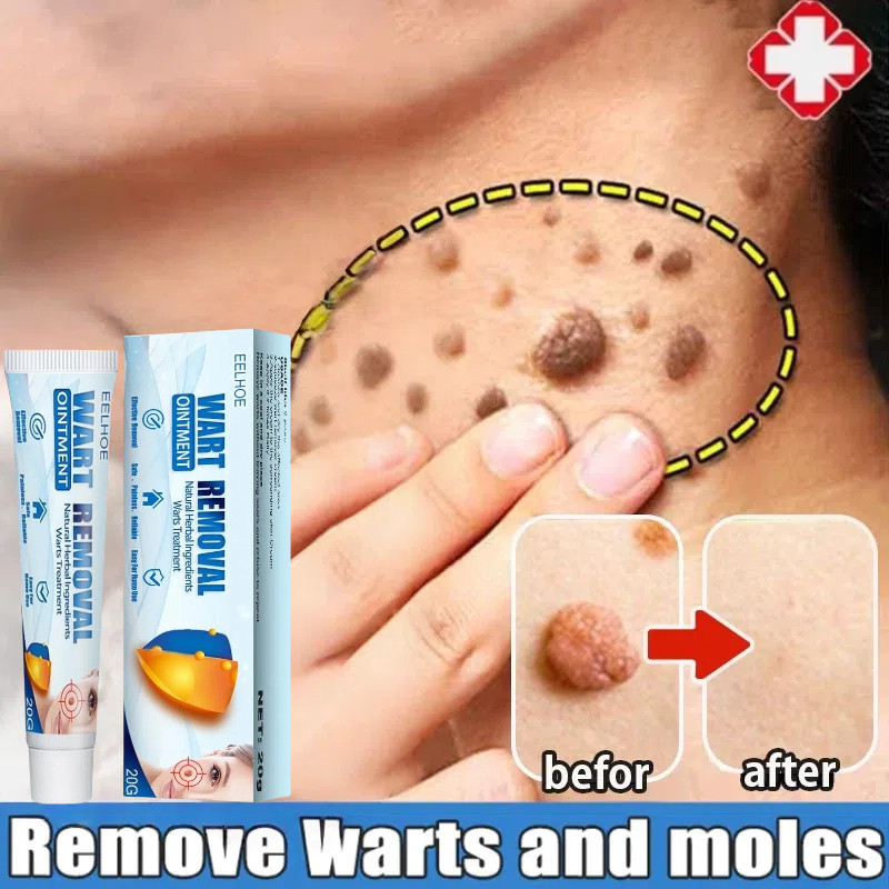 Krim Penghilang Kutil Kutil Tahi Lalat Kutil dan Biji Kolesterol Penghilang Tahi Lalat Penghilang Ta