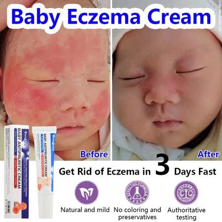 VEROSAE_SHOP Salep eksim bayi Eczema cream bayi Obat eksim alergi kulit bayi cream 15g Biang keringa