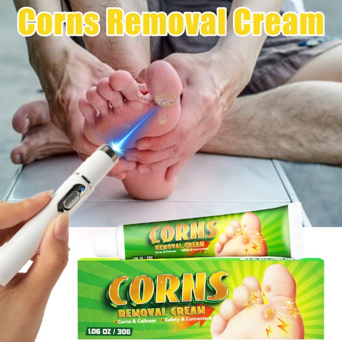 Laser Therapy Corns Remove Cream Chicken Eye Skin Infection Treatment Ointment Foot Dead Skin Callus