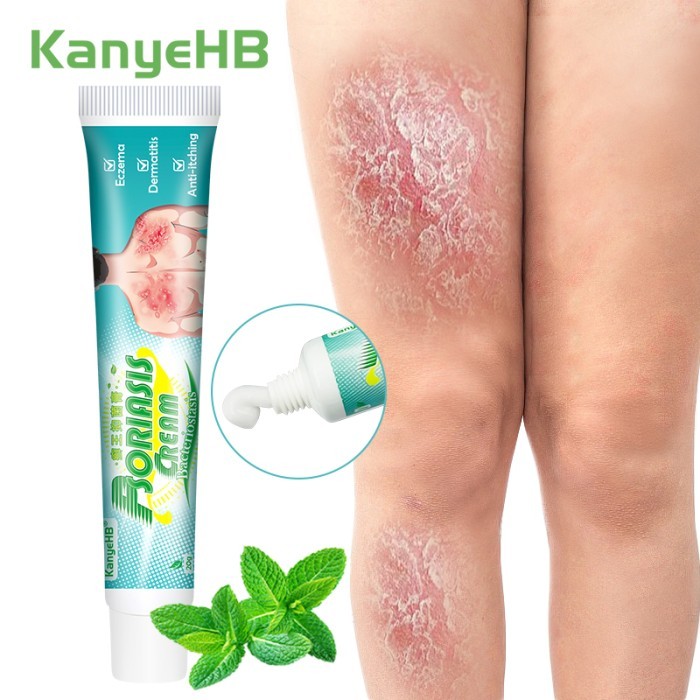 1Pcs Skin Care Psoriasis Ointment Dermatitis Eczema Rash Treatment Antibacterial Cream Beriberi Anti