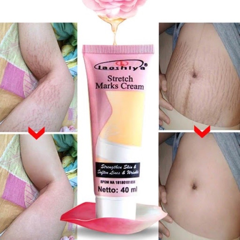 LAOSHIYA STRETCH MARKS CREAM ORIGINAL BPOM - STRETCH MARKS LAOSHIYA