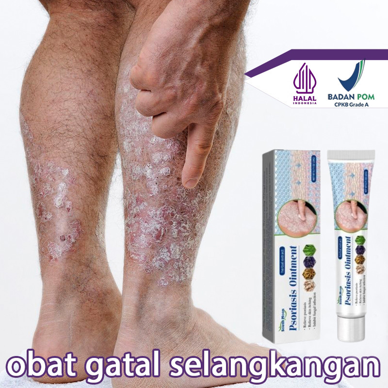 Salep gatal salep china gatal paling ampuh obat gatal obat eksim salep gatal selangkangan Obat Gatal