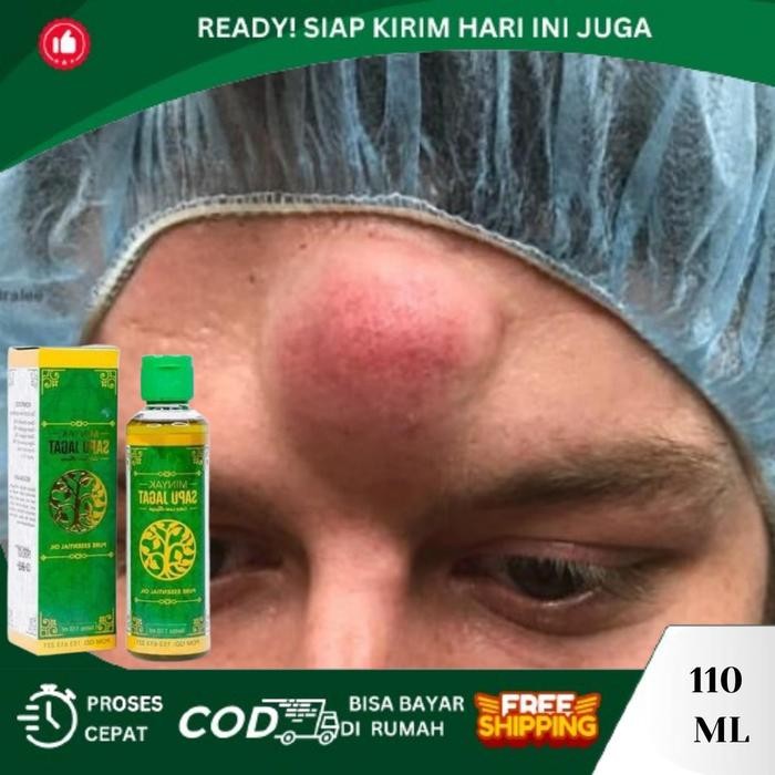 Benjolan Di Dahi, Benjolan Di Kepala, Benjolan Di Jidat, Benjolan Uci Uci, Benjolan Keras Dahi, Miny