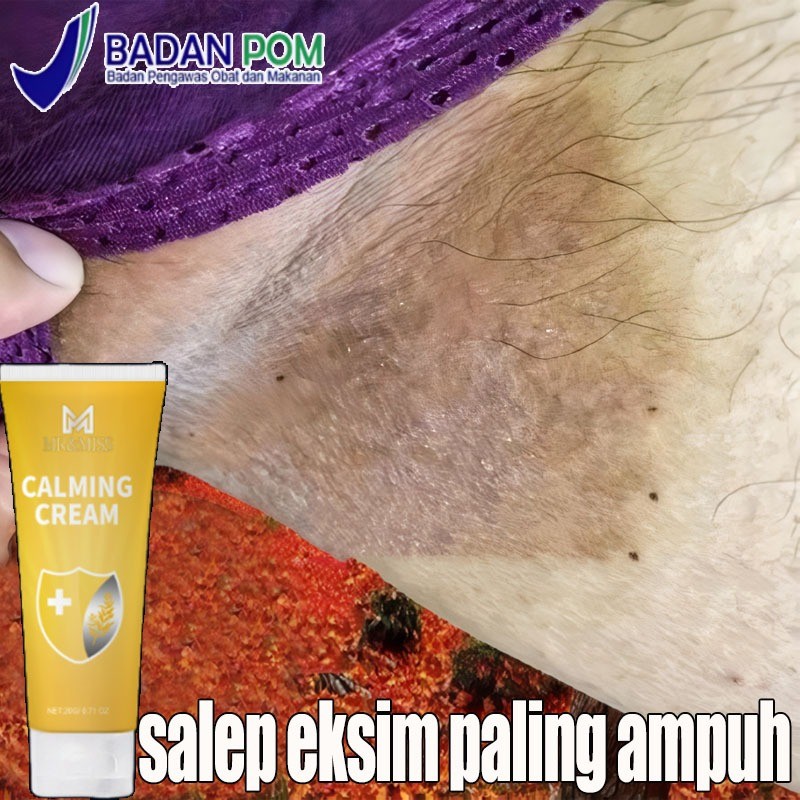 Salep eksim paling ampuh Obat gatal selangkangan Salep gatal selangkangan Obat gatal kulit 20g  sale