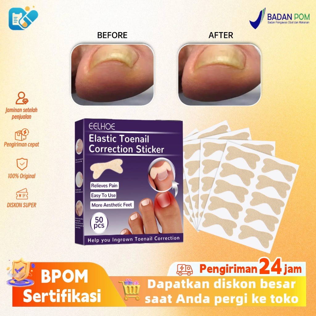 EELHOE elastic toenail sticker 50pcs  Nail Inserts Nail Groove Stiker Kuku Kaki  Nail Repair Ingrown