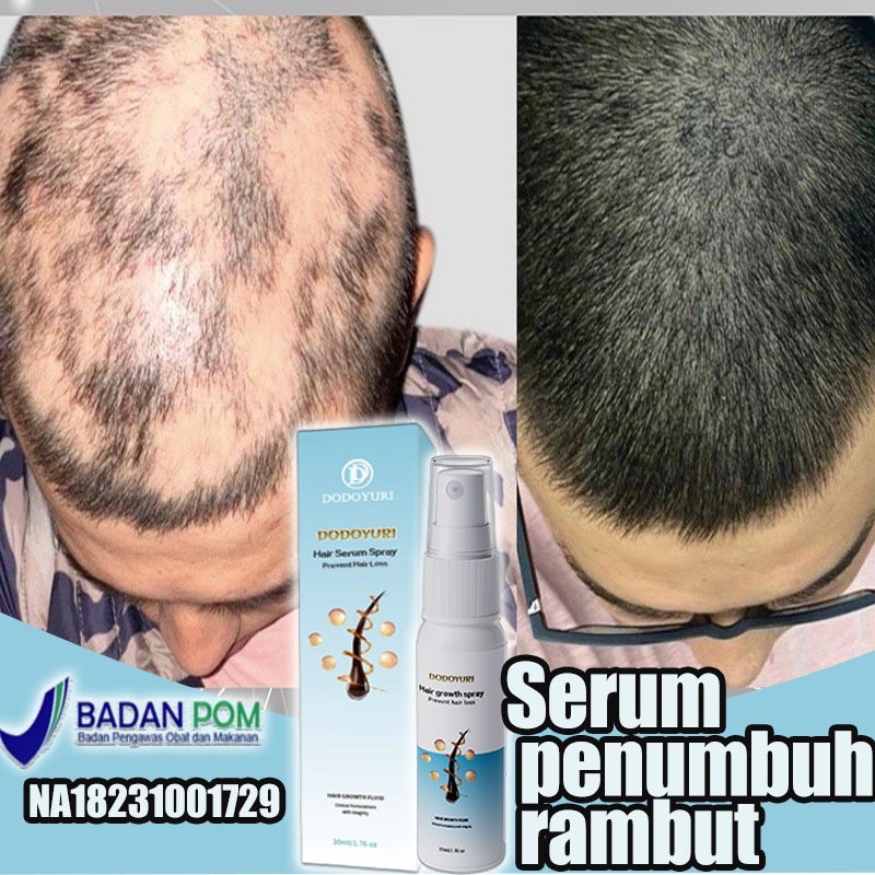 (BPOM)Serum penumbuh rambut Obat penumbuh rambut botak pria
