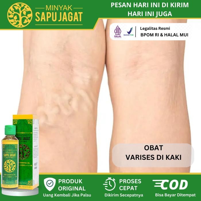 Minyak Penghilang Varises - Minyak Alami untuk Varises, Obat Oles Varises, Obat Nyeri Varises, Urat 